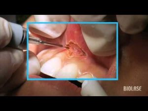 Frenectomy-300x225