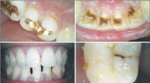 Intraoral-Camera-result-300x167