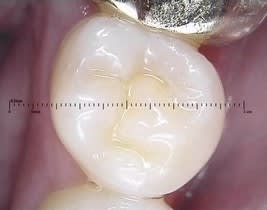 tooth