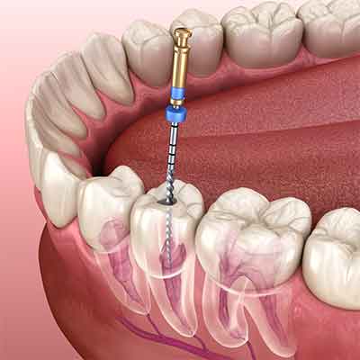 Advancements in Endo World