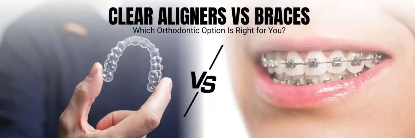 Clear Aligners vs Braces: Which Orthodontic Option Is Right for You?