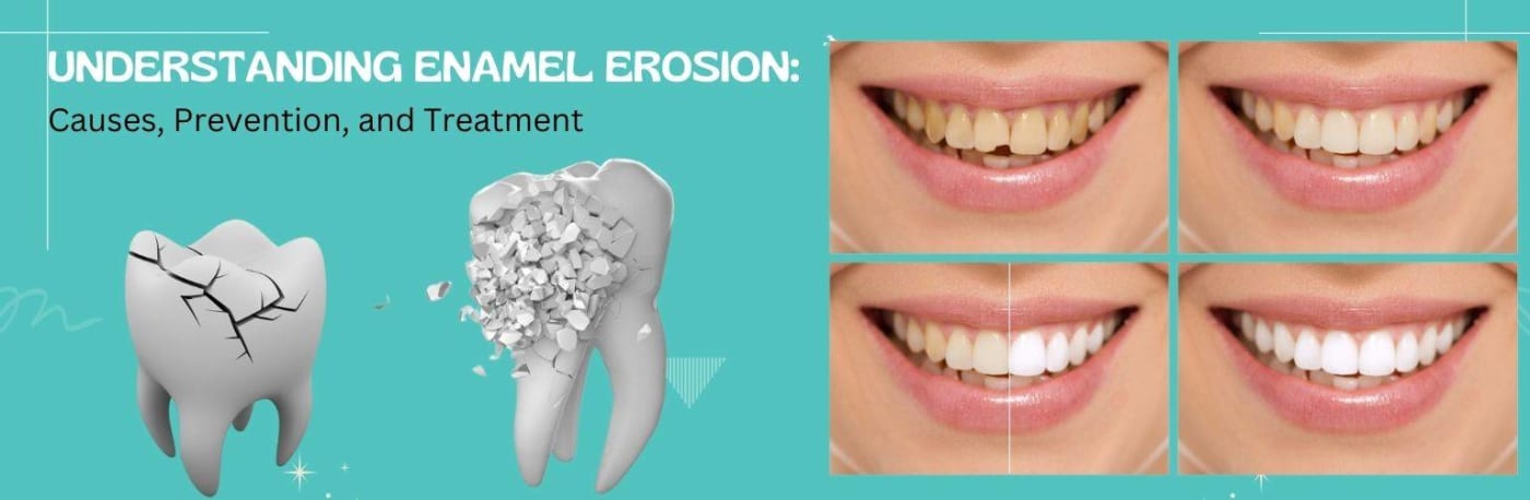 Understanding Enamel Erosion: Causes, Prevention, and Treatment