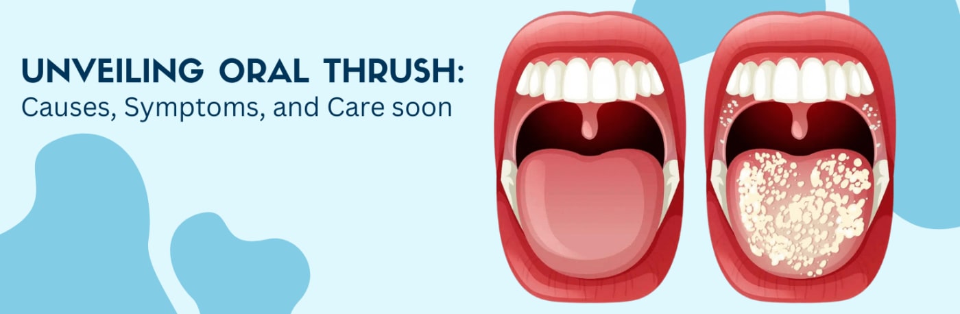 Unveiling Oral Thrush: Causes, Symptoms, and Care