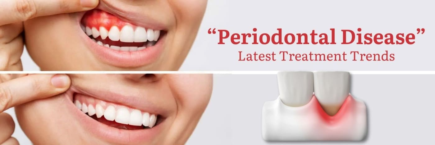 Periodontal Disease: Latest Treatment Trends