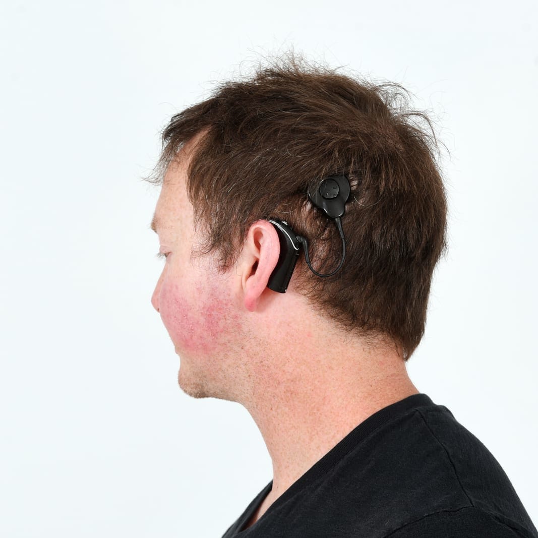 Cochlear implant shot