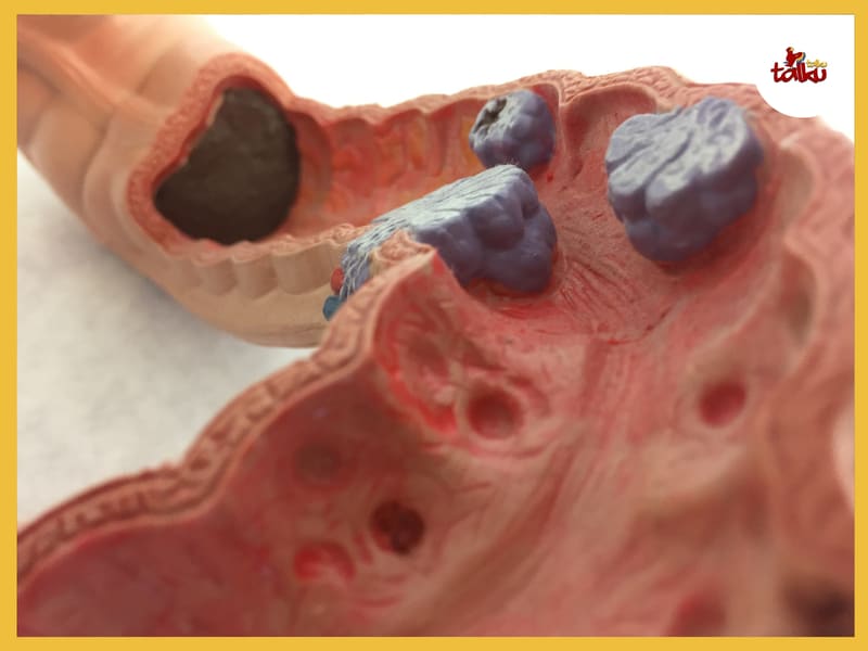 Colon Cancer