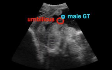 Determining Fetal Sex | ReproScan