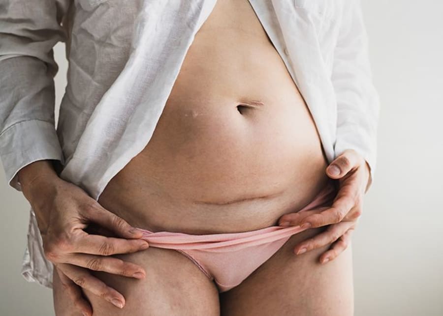 Por qué utilizar una faja para cuidar una hernia umbilical? - Tani Salud