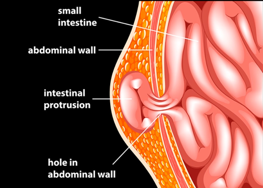 Infomedic - Una hernia umbilical puede no causar síntomas graves