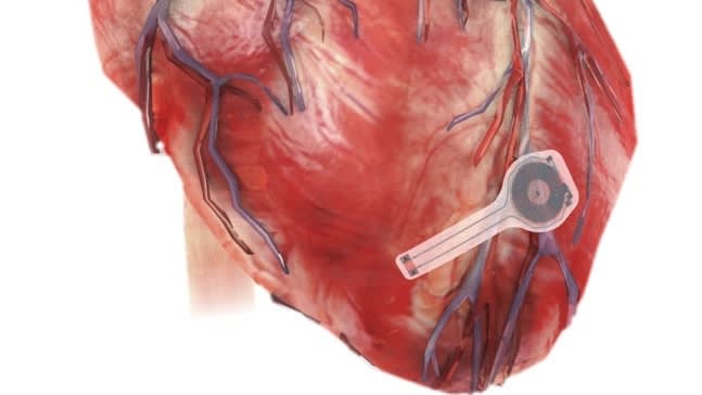 Electric Mesh Device “Hugs” Heart, Improving Cardiac Function