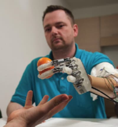 Breakthrough prosthetic fingers revolutionize the lives of