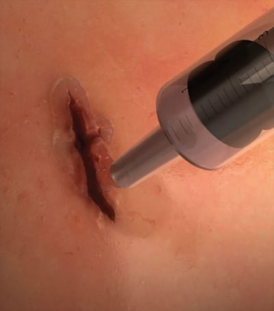 Squirtable Surgical Glue Could Transform Surgeries and Save Lives - Medical  Design Briefs