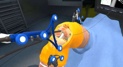 Navio robotic surgery 2025