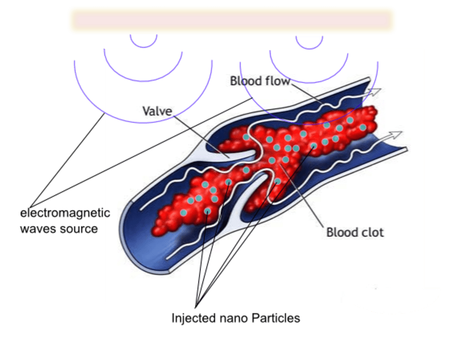 Removing Blood Clots using NanoParticles