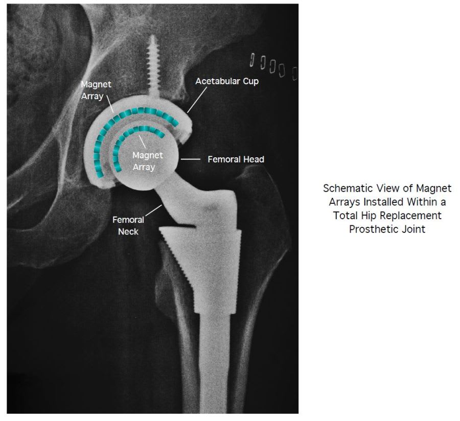 Improved Prosthetic Joints