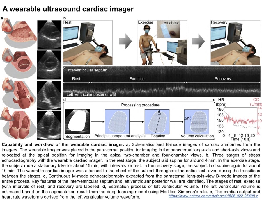 A Wearable Ultrasound Cardiac Imager