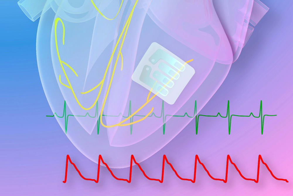 Cardiac Arrhythmia Image
