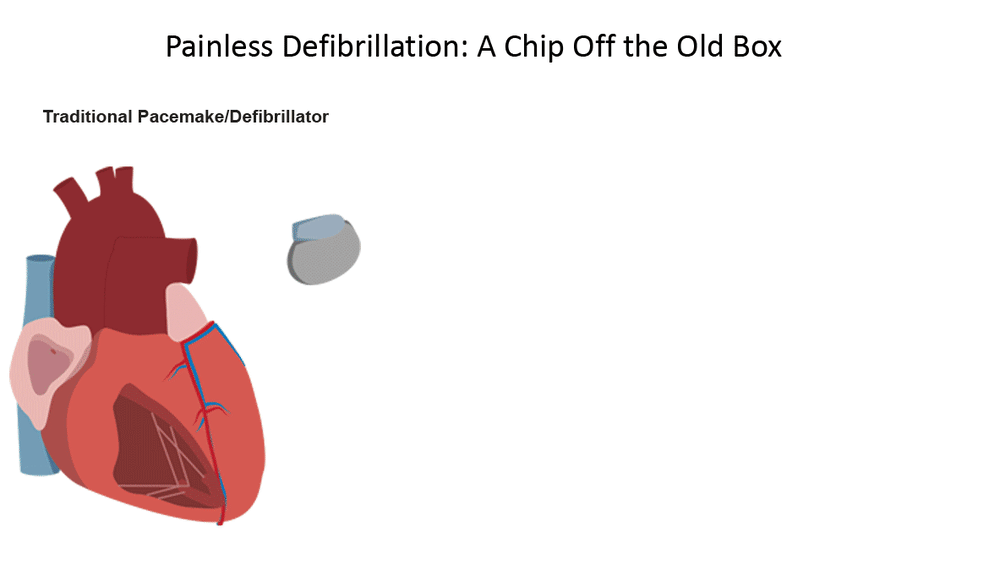 A Chip Off the Old Box Painless Defibrillation