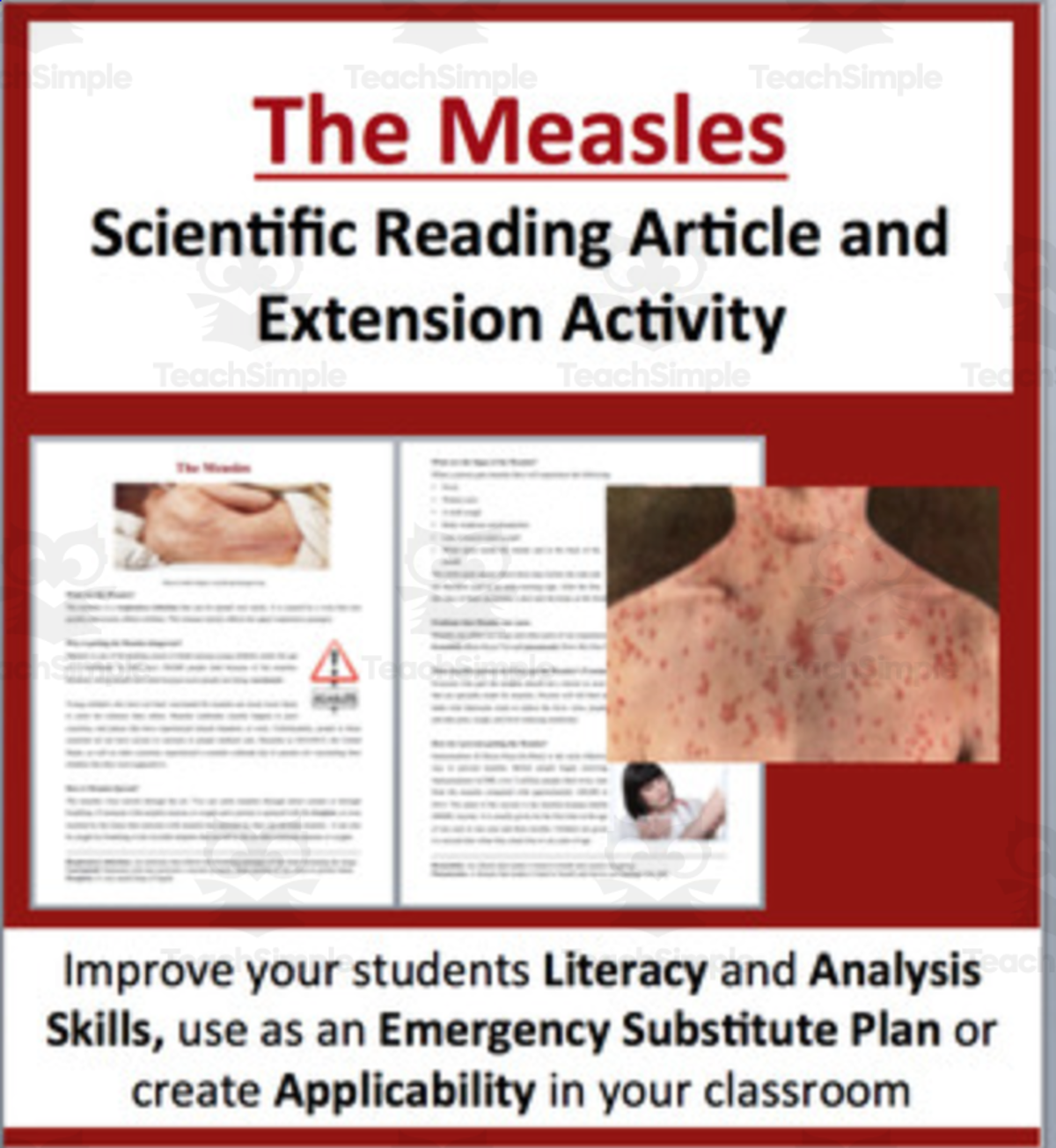 An educational teaching resource from Teach With Fergy entitled The Measles - Science Reading Article - Grades 5-7 downloadable at Teach Simple.