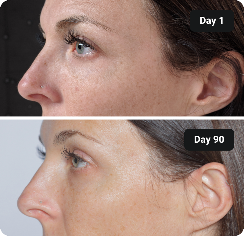 Bioactive Collagen Peptides before and after results