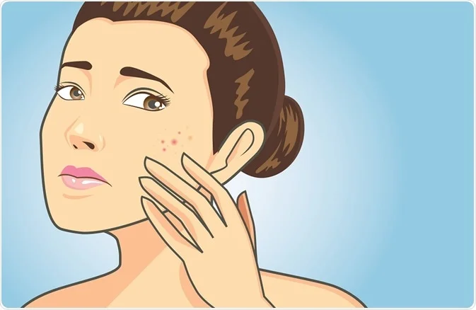 How to Get Rid of Pimple