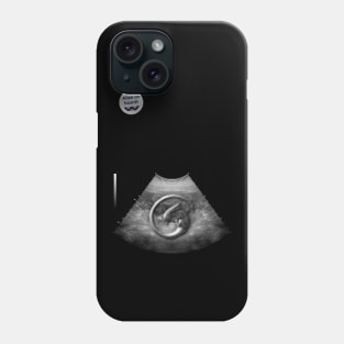 Alien on Board - Ultrasound - badge variant Phone Case