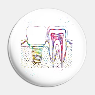 Human teeth and dental implant Pin