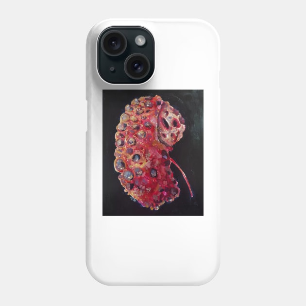 kidney disease Phone Case by drteebu