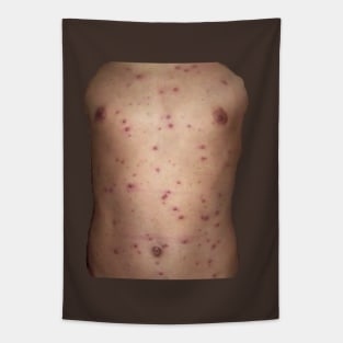 Chickenpox Tapestry