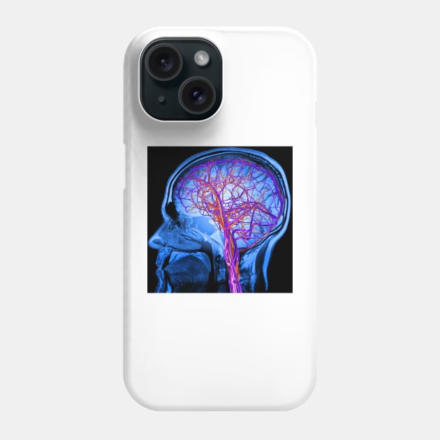 Vascular system of the brain, artwork (C024/6525) Phone Case by SciencePhoto