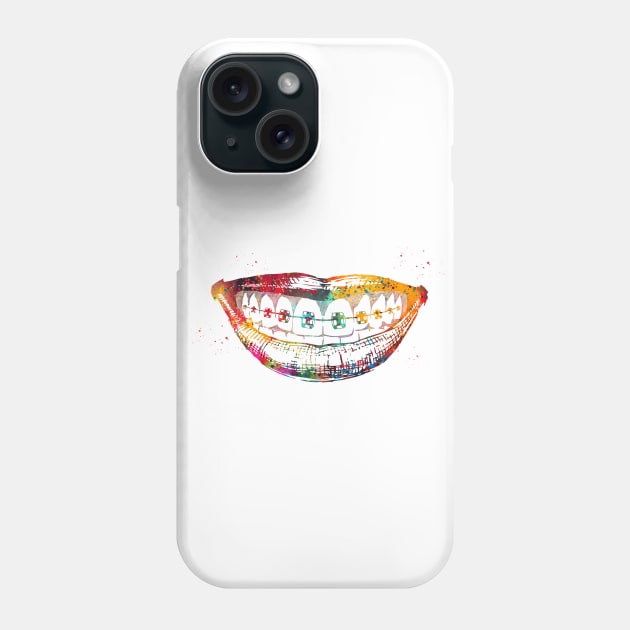 Teeth braces Phone Case by erzebeth