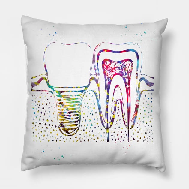 Human teeth and dental implant Pillow by erzebeth