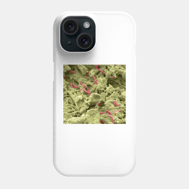 Pseudomonas lung infection, SEM (C021/7004) Phone Case by SciencePhoto