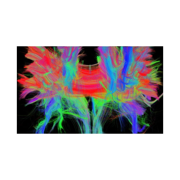 Corpus callosum, DTI MRI scan (C017/7044) by SciencePhoto