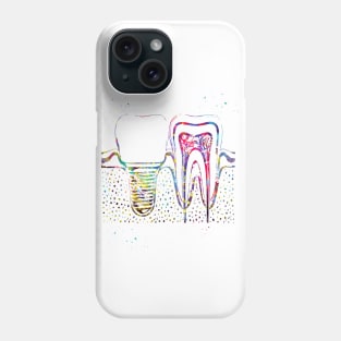 Human teeth and dental implant Phone Case