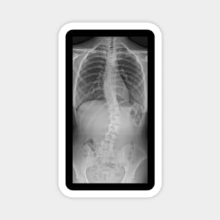 Scoliosis Xray Magnet