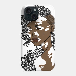 Vitiligo Phone Case