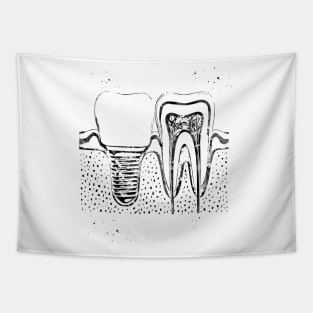 Human teeth and dental implant Tapestry