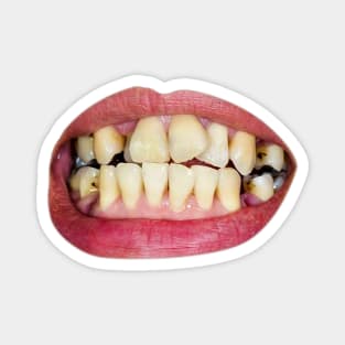 damaged teeth Magnet