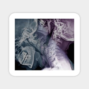 Flexion of the cervical spine, X-rays (C048/0639) Magnet