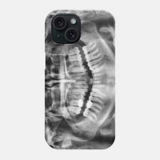 X-Ray Phone Case