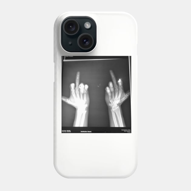 Fingers up Phone Case by pw