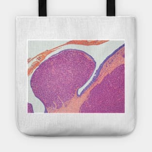 Plasmacytoma, light micrograph (C021/6188) Tote