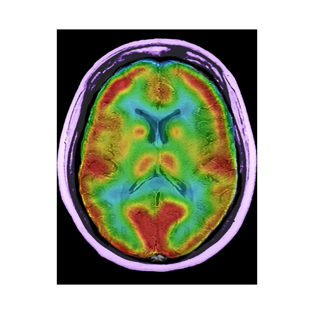 Normal brain blood flow, MRI and SPECT (C026/8000) by SciencePhoto