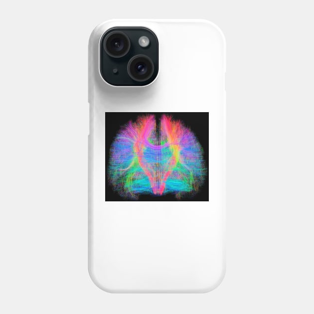 White matter fibres of the human brain (C034/2035) Phone Case by SciencePhoto