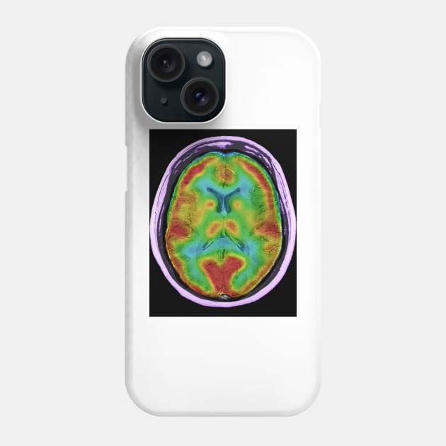 Normal brain blood flow, MRI and SPECT (C026/8000) Phone Case by SciencePhoto