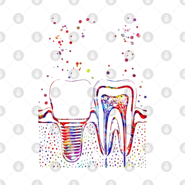 Human teeth and dental implant, by RosaliArt