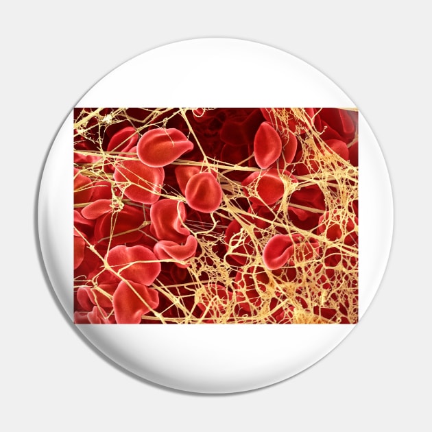 Blood clot, SEM (P260/0107) Pin by SciencePhoto