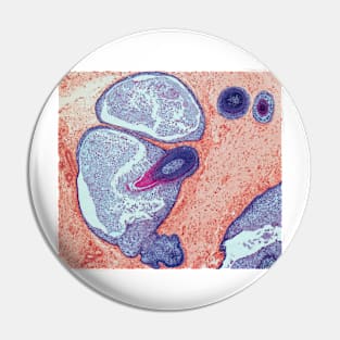 Dermoid ovarian cyst, light micrograph (C019/9256) Pin