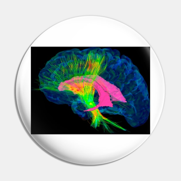 Brain fibres, DTI MRI scan (C017/7036) Pin by SciencePhoto